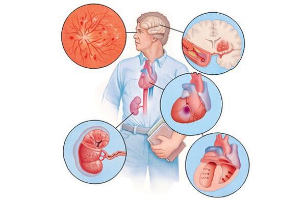 Endommager plusieurs organes souffrant d'hypertension artérielle prolongée