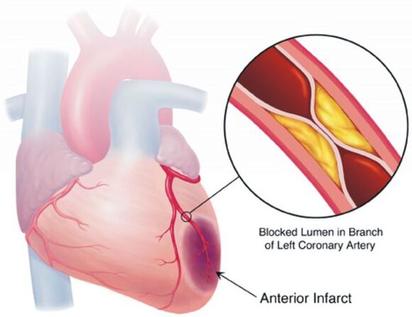 L'une des complications de l'hypertension est la maladie coronarienne